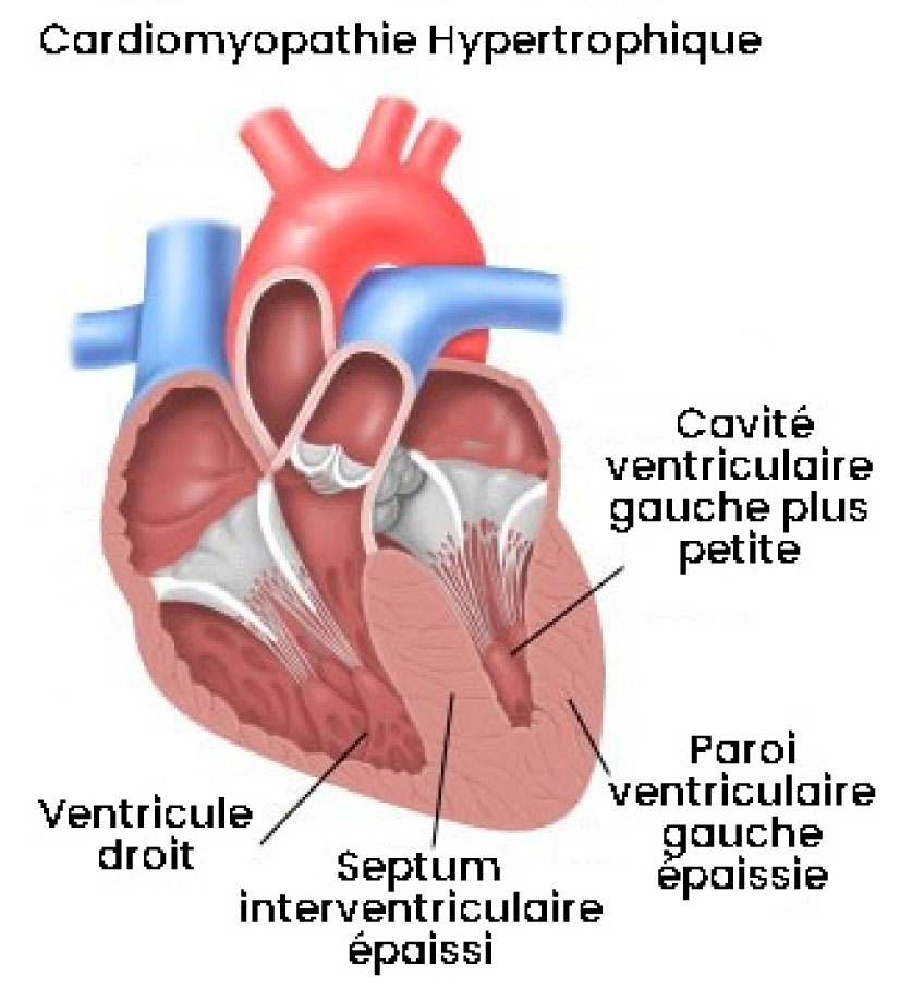 La cardiomyopathie hypertrophique de quoi s’agitil ? Fédération Française de Cardiologie
